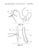 TISSUE PROTECTOR SUTURE CONSTRUCTS diagram and image