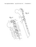 Dynamic Compression Plate diagram and image