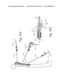 Dynamic Compression Plate diagram and image