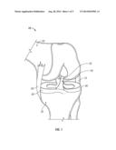 IMPLANT FOR PROMOTING STABILITY OF THE CANINE STIFLE JOINT diagram and image