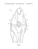IMPLANT FOR PROMOTING STABILITY OF THE CANINE STIFLE JOINT diagram and image