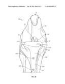 IMPLANT FOR PROMOTING STABILITY OF THE CANINE STIFLE JOINT diagram and image