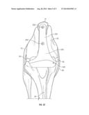 IMPLANT FOR PROMOTING STABILITY OF THE CANINE STIFLE JOINT diagram and image