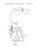 NEUROSTIMULATION CONTROLLED BY ASSESSMENT OF CARDIOVASCULAR RISK diagram and image