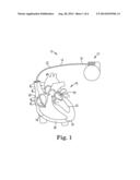 IMPLANTABLE MEDICAL DEVICE INCLUDING ASSEMBLY INCORPORATING RADIOPAQUE     AGENT AND ELUTABLE DRUG INTO A POLYMERIC LEAD TIP diagram and image