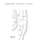 Inversion Delivery Device and Method For A Prosthesis diagram and image