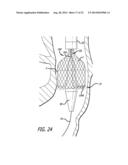 Inversion Delivery Device and Method For A Prosthesis diagram and image