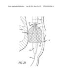 Inversion Delivery Device and Method For A Prosthesis diagram and image