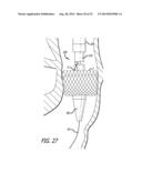 Inversion Delivery Device and Method For A Prosthesis diagram and image