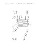 Inversion Delivery Device and Method For A Prosthesis diagram and image