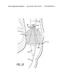 Inversion Delivery Device and Method For A Prosthesis diagram and image