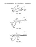 NASAL IMPLANTS AND SYSTEMS AND METHODS OF USE diagram and image