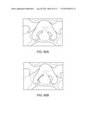 NASAL IMPLANTS AND SYSTEMS AND METHODS OF USE diagram and image