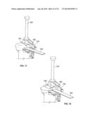 BICRUCIATE RETAINING TIBIAL IMPLANT SYSTEM diagram and image