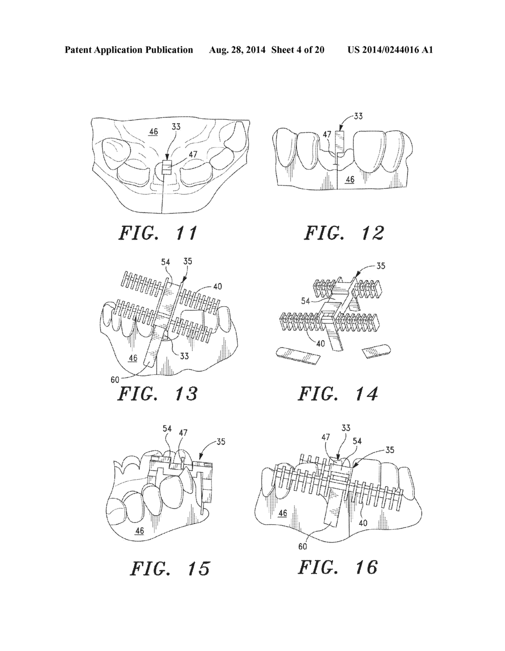 SURGICAL GUIDE AND METHOD - diagram, schematic, and image 05