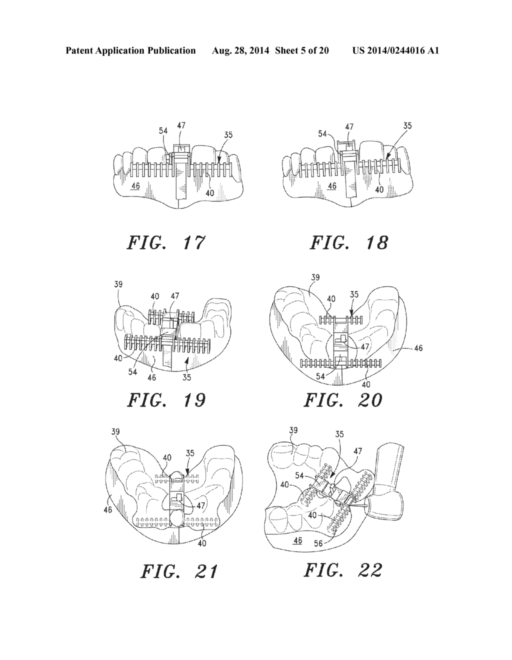 SURGICAL GUIDE AND METHOD - diagram, schematic, and image 06