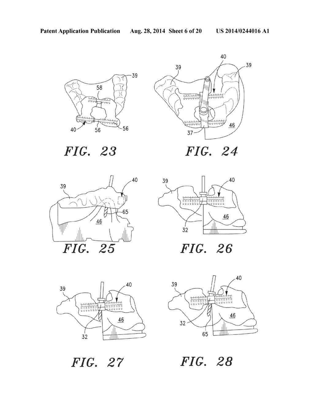 SURGICAL GUIDE AND METHOD - diagram, schematic, and image 07