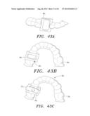 SURGICAL GUIDE AND METHOD diagram and image