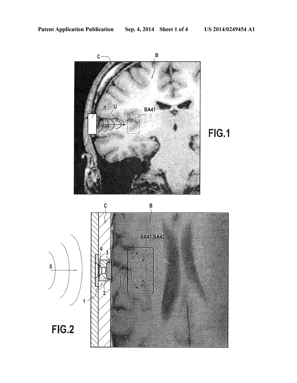 DEVICE FOR TREATING THE SENSORY CAPACITY OF A PERSON AND METHOD OF     TREATMENT WITH THE HELP OF SUCH A DEVICE - diagram, schematic, and image 02