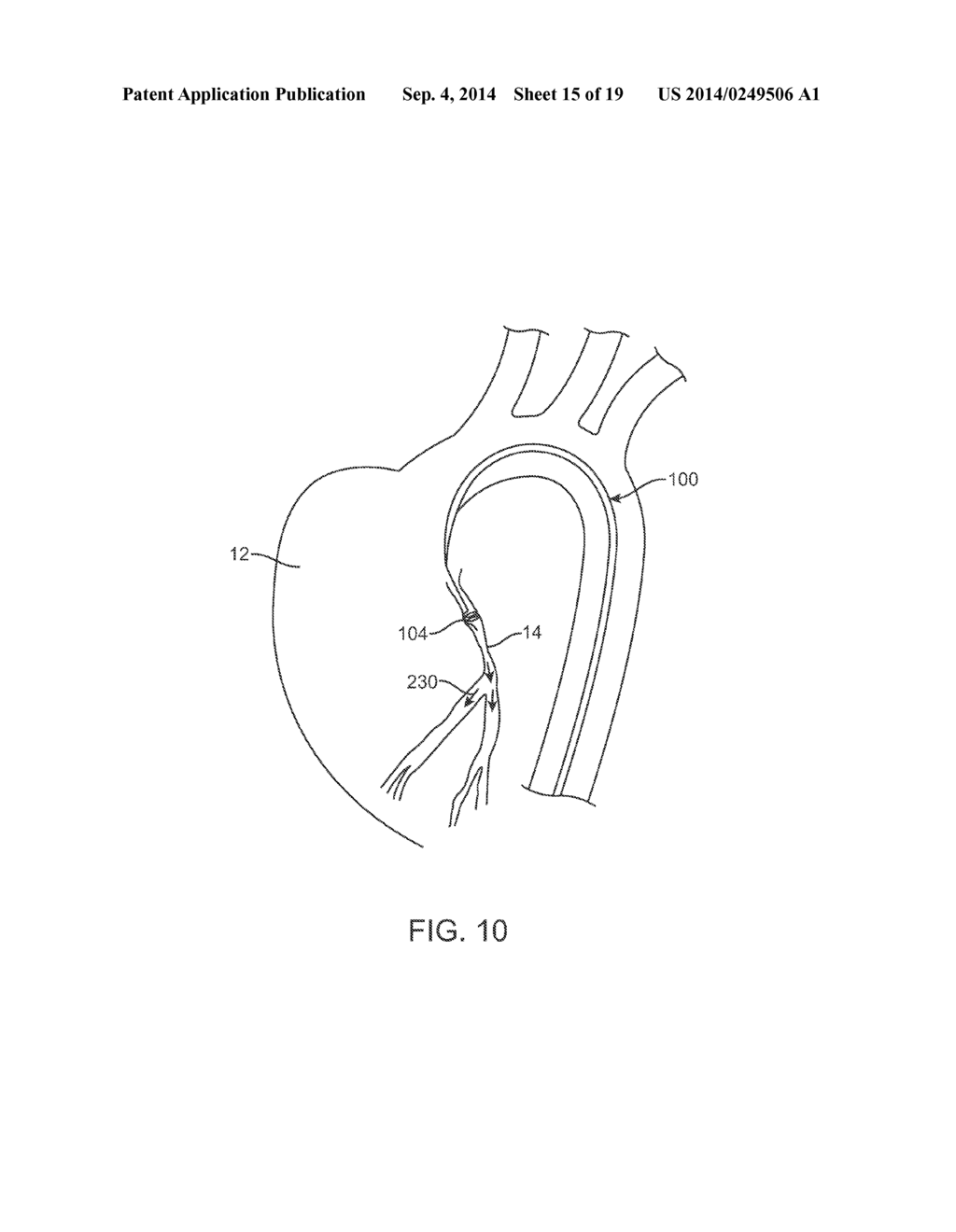 HELICAL BALLOON CATHETER - diagram, schematic, and image 16