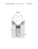 DEVICE FOR TREATING PERI-IMPLANTITIS diagram and image
