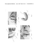 Simplified Protocol for Fixed Implant Restorations Using Intra-Oral     Scanning and Dental CAD/CAM diagram and image