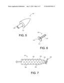 ADJUSTABLE IMPLANTS AND METHODS OF IMPLANTING THE SAME diagram and image