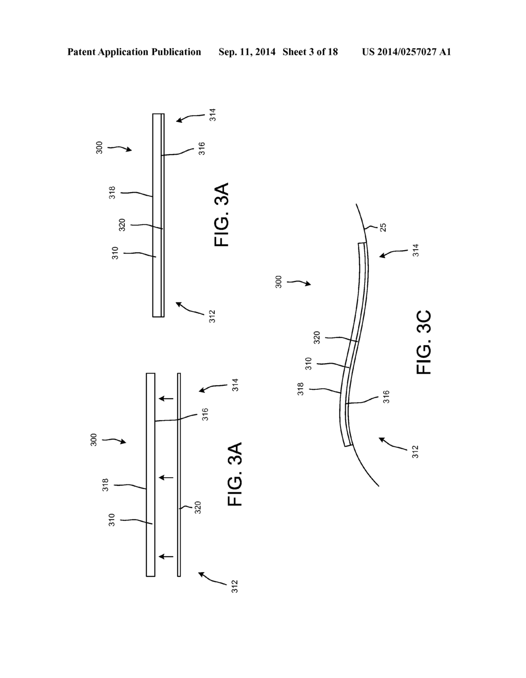 IMPLANTABLE MEDICAL DEVICE AND METHODS OF DELIVERING THE IMPLANTABLE     MEDICAL DEVICE - diagram, schematic, and image 04