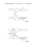 DEVICE FOR PREVENTION OF SHUNT STENOSIS diagram and image