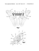 IMPROVEMENTS IN AND RELATING TO IMPLANTS diagram and image