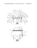 IMPROVEMENTS IN AND RELATING TO IMPLANTS diagram and image