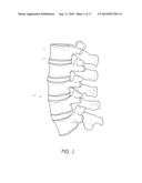 METHOD AND APPARATUS FOR MINIMALLY INVASIVE INSERTION OF INTERVERTEBRAL     IMPLANTS diagram and image