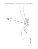 METHOD AND APPARATUS FOR MINIMALLY INVASIVE INSERTION OF INTERVERTEBRAL     IMPLANTS diagram and image