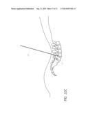 METHOD AND APPARATUS FOR MINIMALLY INVASIVE INSERTION OF INTERVERTEBRAL     IMPLANTS diagram and image