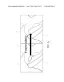 METHOD AND APPARATUS FOR MINIMALLY INVASIVE INSERTION OF INTERVERTEBRAL     IMPLANTS diagram and image