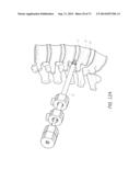 METHOD AND APPARATUS FOR MINIMALLY INVASIVE INSERTION OF INTERVERTEBRAL     IMPLANTS diagram and image