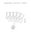 METHOD AND APPARATUS FOR MINIMALLY INVASIVE INSERTION OF INTERVERTEBRAL     IMPLANTS diagram and image