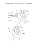 SYSTEMS AND METHODS FOR THE FUSION OF THE SACRAL-ILIAC JOINT diagram and image