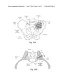 SYSTEMS AND METHODS FOR THE FUSION OF THE SACRAL-ILIAC JOINT diagram and image