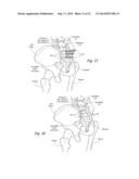 SYSTEMS AND METHODS FOR THE FUSION OF THE SACRAL-ILIAC JOINT diagram and image