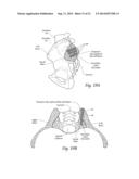 SYSTEMS AND METHODS FOR THE FUSION OF THE SACRAL-ILIAC JOINT diagram and image