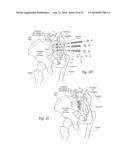 SYSTEMS AND METHODS FOR THE FUSION OF THE SACRAL-ILIAC JOINT diagram and image