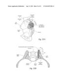 SYSTEMS AND METHODS FOR THE FUSION OF THE SACRAL-ILIAC JOINT diagram and image