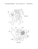 SYSTEMS AND METHODS FOR THE FUSION OF THE SACRAL-ILIAC JOINT diagram and image