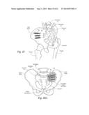 SYSTEMS AND METHODS FOR THE FUSION OF THE SACRAL-ILIAC JOINT diagram and image