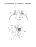 SYSTEMS AND METHODS FOR THE FUSION OF THE SACRAL-ILIAC JOINT diagram and image