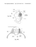 SYSTEMS AND METHODS FOR THE FUSION OF THE SACRAL-ILIAC JOINT diagram and image