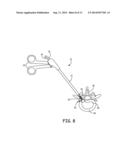 RONGEUR AND METHOD FOR STIFFENING, GRASPING AND REMOVING TISSUE FROM A     REGION OF THE SPINE diagram and image