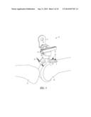 EXTRAMEDULLARY RESECTION GUIDE AND METHODS diagram and image