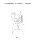 EXTRAMEDULLARY RESECTION GUIDE AND METHODS diagram and image